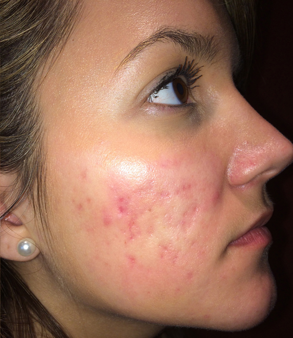 Microneedling After