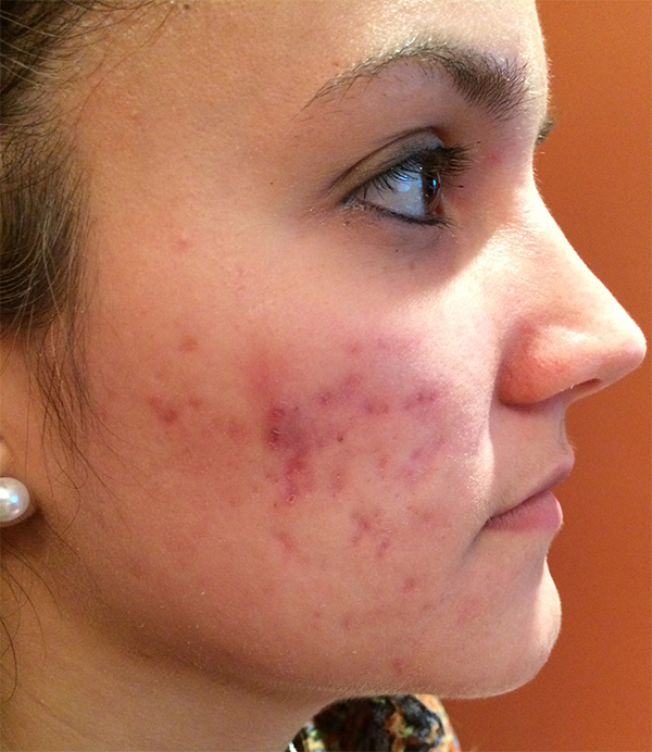 Microneedling Before