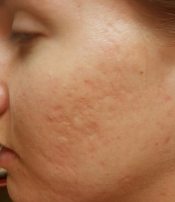 Microneedling After