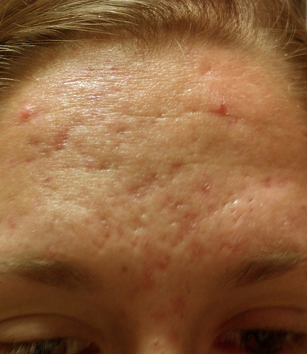 Microneedling Before